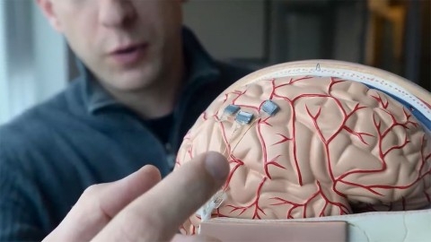 New Brain Implant Begins Human Trials